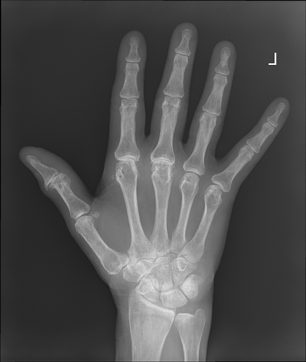 Wrist osteoarthritis